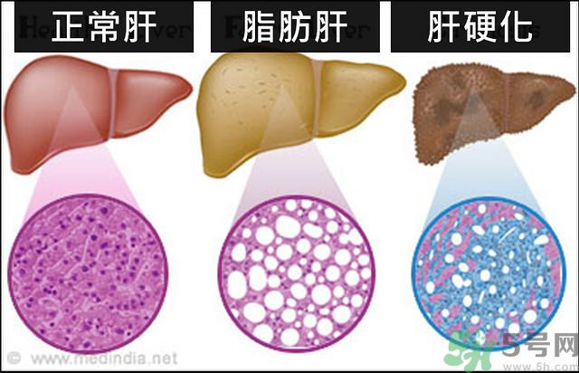 得了脂肪肝該怎么治？脂肪肝對人體危害有多大？
