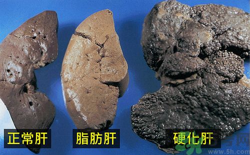 得了脂肪肝該怎么治？脂肪肝對人體危害有多大？