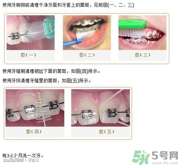 18歲還能戴牙套嗎？戴牙套真的能瘦臉改變臉型嗎？