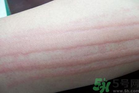蕁麻疹會不會傳染？蕁麻疹怎么治才能好？