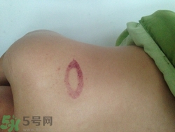 種草莓吻痕是什么意思？吻痕是怎么弄出來的？