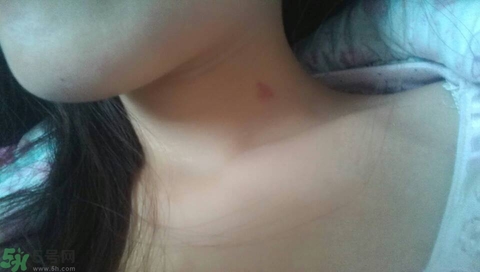 種草莓吻痕是什么意思？吻痕是怎么弄出來的？