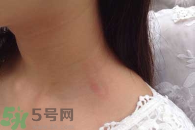 種草莓吻痕是什么意思？吻痕是怎么弄出來的？