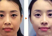 激光美白多少錢？激光美白價格