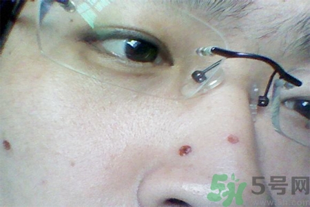 激光點痣后可以洗臉嗎？激光點痣后需要注意什么？