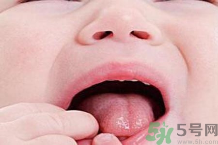 寶寶口腔潰瘍怎么辦？治療寶寶口腔潰瘍方法有什么？