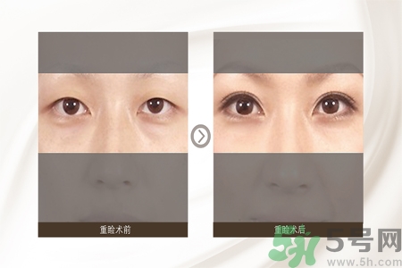 割雙眼皮分哪幾種？割雙眼皮需要多少錢？