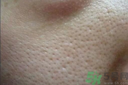 皮膚毛孔粗大原因有哪些？如何預(yù)防皮膚毛孔粗大？