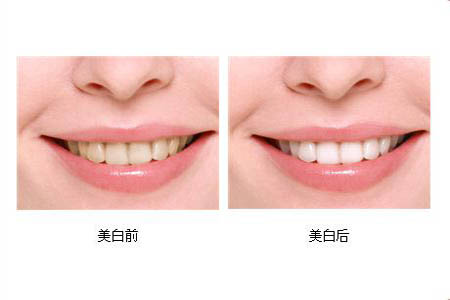 冷光美白牙齒可以保持多長時(shí)間？冷光美白牙齒有副作用嗎？