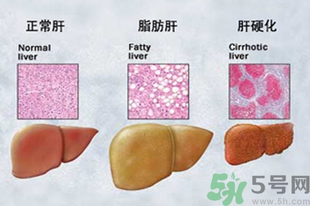 妊娠急性脂肪肝是什么？妊娠急性脂肪肝的治療方法？