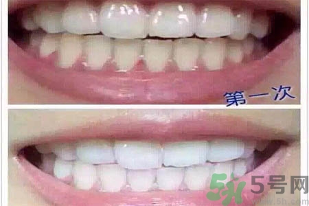 冷光美白牙齒的價(jià)格是多少？做冷光美白牙齒需要多少錢(qián)？