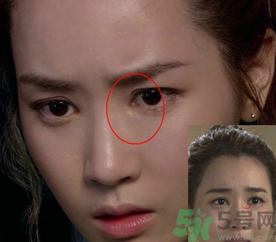 開眼角多少錢？開眼角有什么危害？