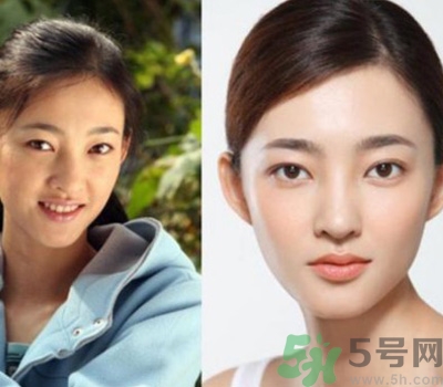 開眼角眼睛會變大嗎？開眼角眼睛能大多少？