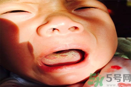 舌頭燙傷后該怎么辦呢？舌頭燙傷后應(yīng)該注意吃什么？?