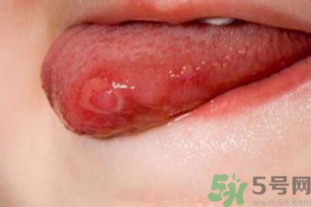 舌頭長泡怎么辦？舌頭長泡的原因？