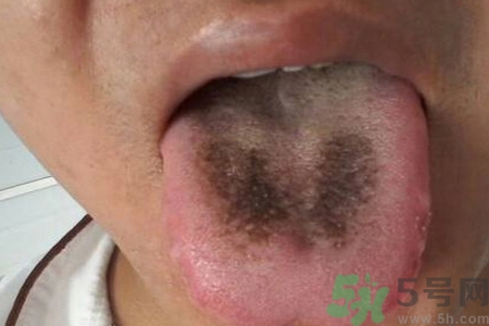 舌頭發(fā)黑怎么回事？舌頭發(fā)黑怎么辦？
