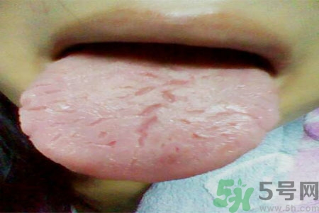 舌頭上有裂紋是怎么辦？舌頭上有裂紋是什么原因？