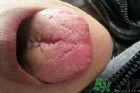 舌頭上有裂紋是怎么辦？舌頭上有裂紋是什么原因？