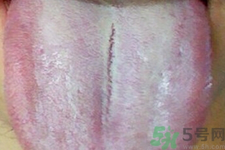 舌頭發(fā)白是什么原因？舌苔發(fā)白是怎么辦？