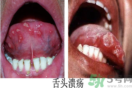 舌頭潰瘍?cè)趺崔k？舌頭潰瘍的原因？