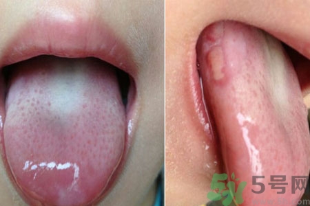 舌頭潰瘍?cè)趺崔k？舌頭潰瘍的原因？