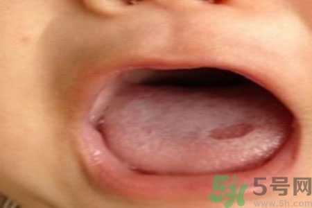 舌頭潰瘍?cè)趺崔k？舌頭潰瘍的原因？