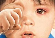 寶寶得了紅眼病怎么辦？寶寶得了紅眼病怎么治？