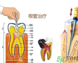 什么是根管治療？為什么牙齒疼要做根管治療？