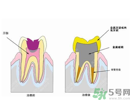什么是根管治療？為什么牙齒疼要做根管治療？