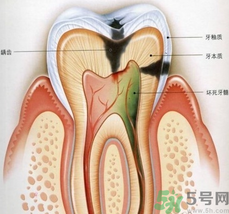 什么是根管治療？為什么牙齒疼要做根管治療？