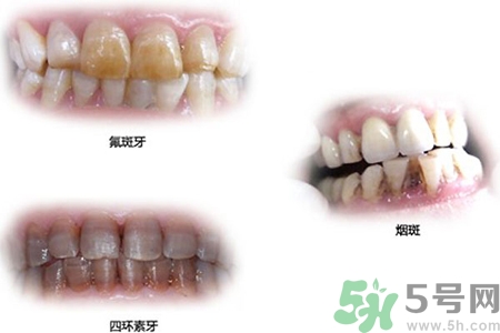 四環(huán)素牙是什么？四環(huán)素牙是怎么形成的？