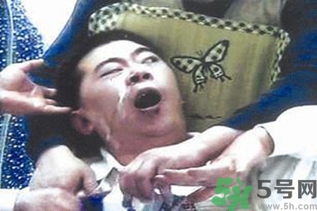 癲癇的典型癥狀有哪些？癲癇是什么？