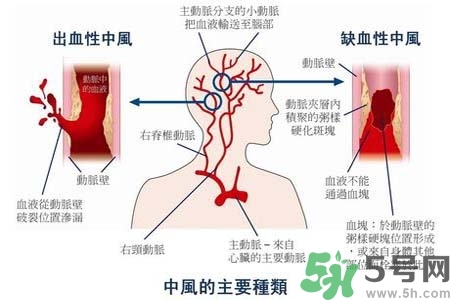 腦中風(fēng)是什么？腦中風(fēng)的癥狀？