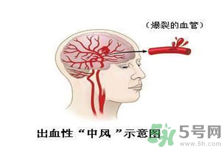 腦中風(fēng)的護(hù)理措施？腦中風(fēng)的飲食護(hù)理？