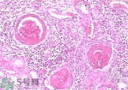慢性腎炎能治好嗎？慢性腎炎能活多久？