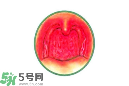 慢性咽炎的治療方法？慢性咽炎的藥物治療？