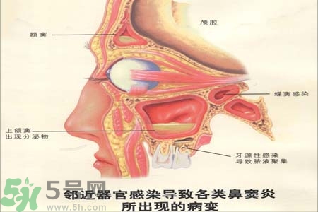 鼻竇炎是什么？鼻竇炎的癥狀有哪些？