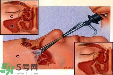 鼻竇炎的高發(fā)人群？如何預(yù)防鼻竇炎？