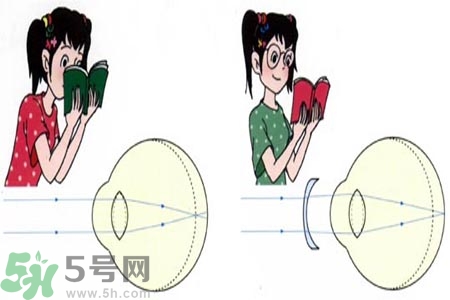 近視眼的發(fā)病因素？近視眼的并發(fā)癥有哪些？