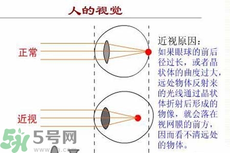 近視眼高發(fā)人群？如何預(yù)防近視眼？