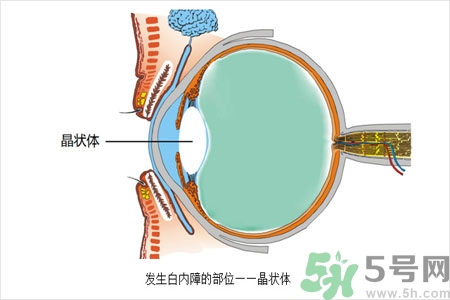 白內(nèi)障的護理措施是什么？白內(nèi)障的飲食護理有哪些？