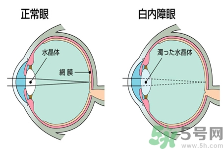 白內(nèi)障治療方法是什么？白內(nèi)障可以用什么藥物治療？