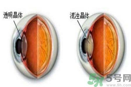 白內(nèi)障治療方法是什么？白內(nèi)障可以用什么藥物治療？