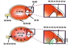 青光眼的發(fā)病因素是什么？青光眼的并發(fā)癥有哪些？