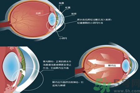 青光眼的高發(fā)人群有哪些？如何預(yù)防青光眼？