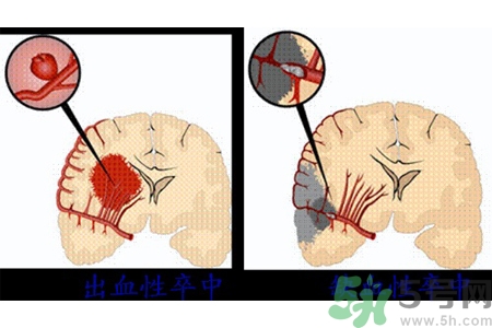 腦出血的發(fā)病因素是什么？腦出血的并發(fā)癥有哪些？