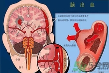 腦出血的發(fā)病因素是什么？腦出血的并發(fā)癥有哪些？