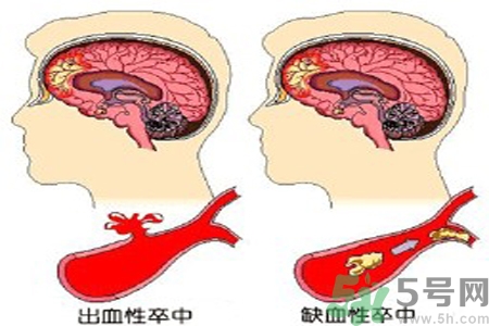 腦出血的治療方法是什么？腦出血可以用哪些藥物治療？