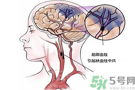 腦出血的治療方法是什么？腦出血可以用哪些藥物治療？