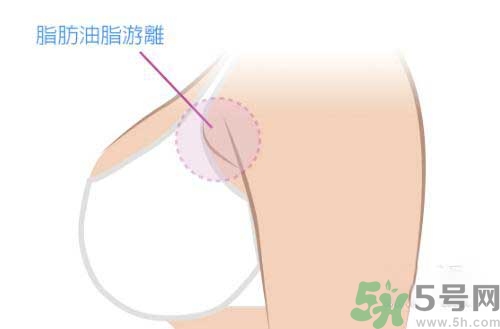 副乳是什么？副乳的危害